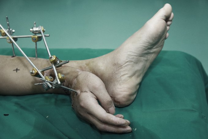 Xiao Wei lost his right hand in an accident at work but could not have it reattached to his arm right away. Instead, the hand was kept alive by stitching it to Mr Wei's left ankle and "borrowing" a blood supply from arteries in the leg